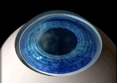 La greffe de cornée